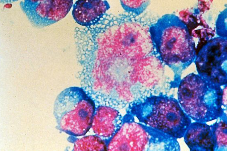 Nuovo e più aggressivo ceppo HIV scoperto a Cuba