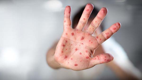 Ragazza muore per morbillo a Catania